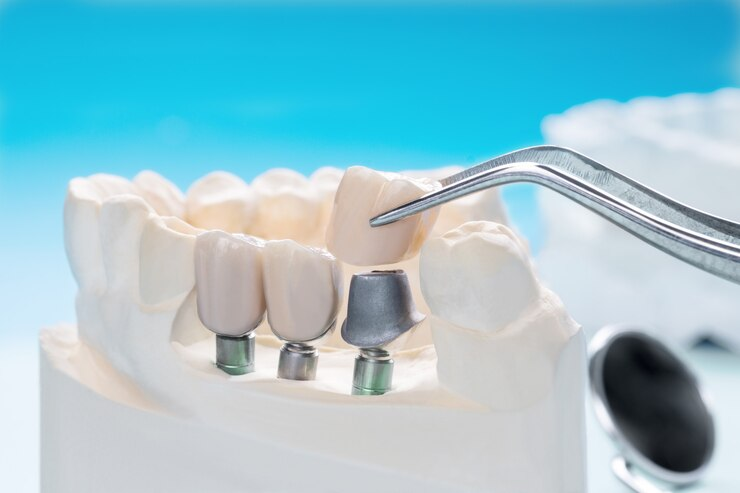 dental implant session cost